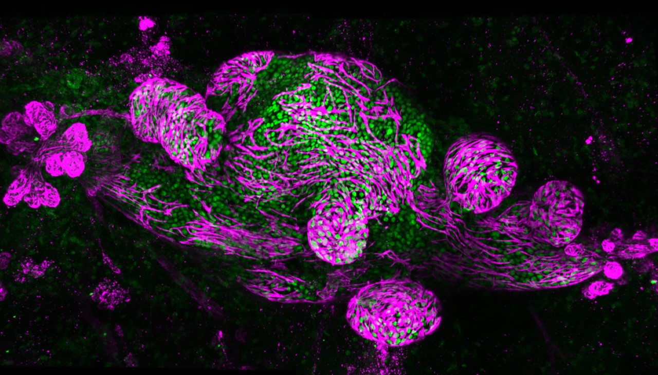 Microscopic image of  human Ductal Carcinoma In Situ (Green) tumor cells growing inside the mammary duct